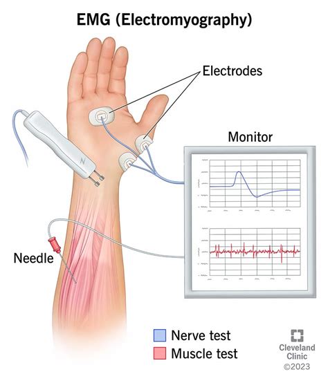 Electromyography and Nerve Conduction Velocity (EMG.